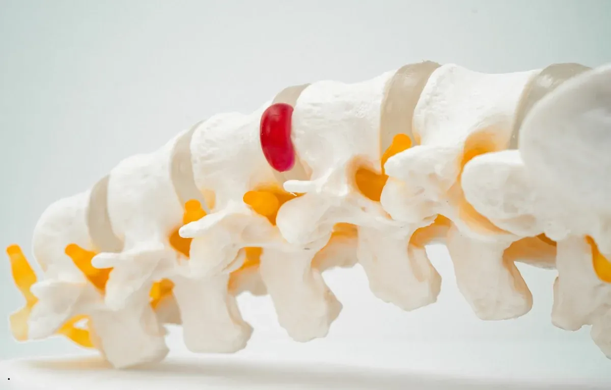 A lumbar spine model with a highlighted disc bulging between two vertebrae.